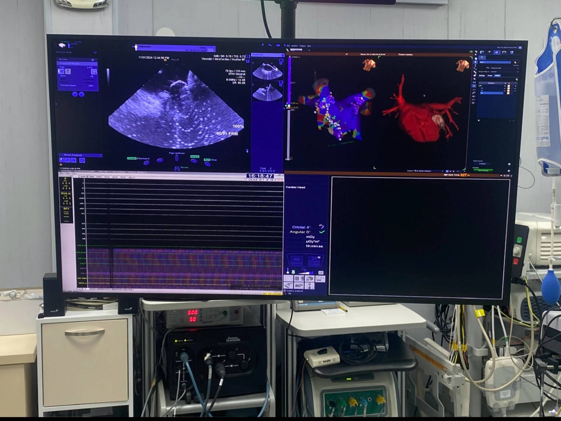  Kриоаблация на белодробни вени без рентгеново облъчване 
